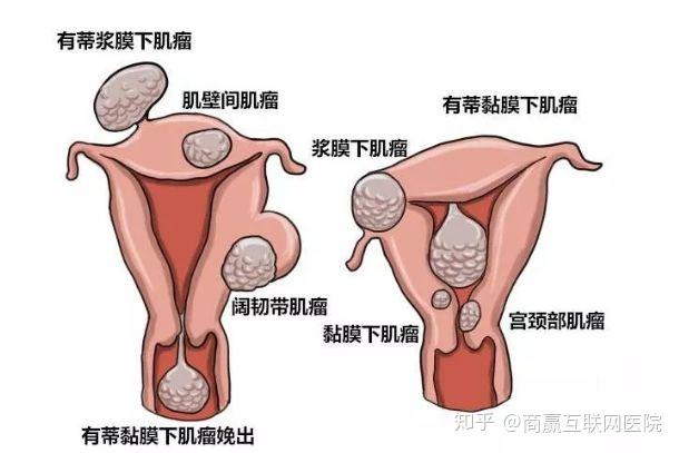 子宫肌瘤最新最佳治疗方法，自信与成就感的源泉探索