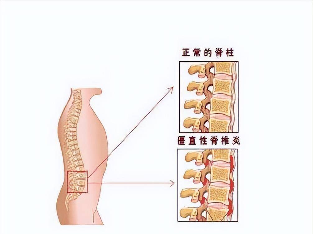 最新强直性脊柱炎疗法，告别疼痛，重拾活力！