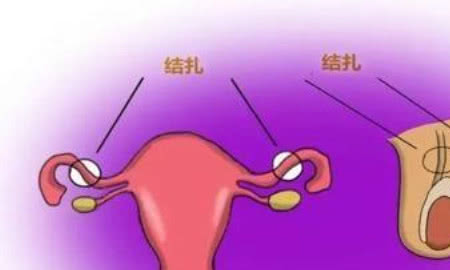 女性结扎最新方法与观点阐述解析