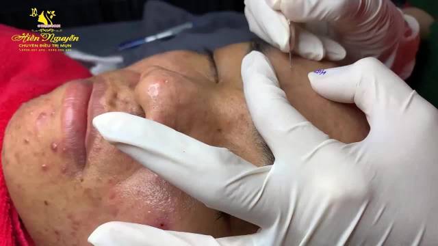 挤痘痘视频最新，心灵与自然的奇妙之旅