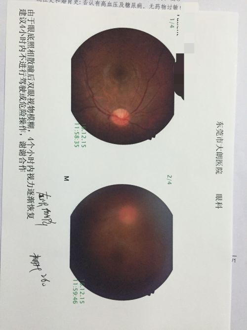 玻璃体混浊最新特效药观点论述与疗效解析